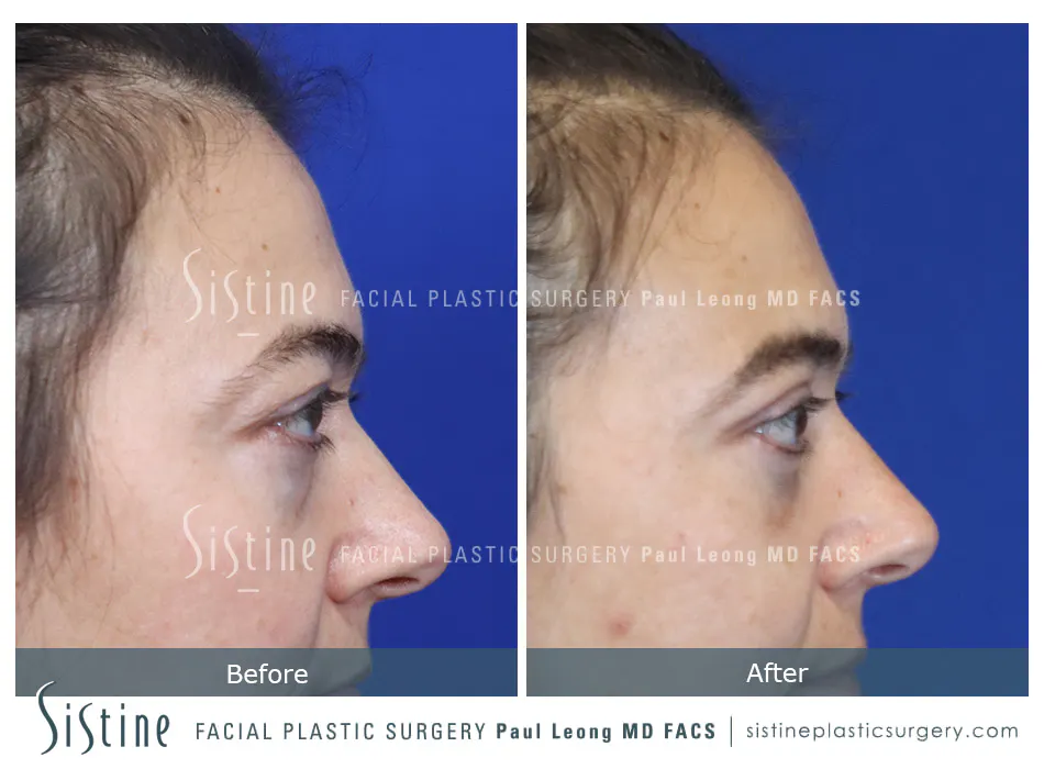 Fat Transfer Injections Before and After | Leong Facial Plastic Surgery