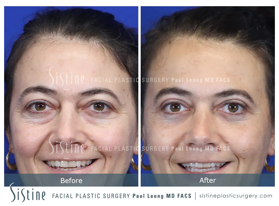 Pittsburgh High SMAS Facelift - Preoperative Left Oblique View | Sistine Facial Plastic Surgery