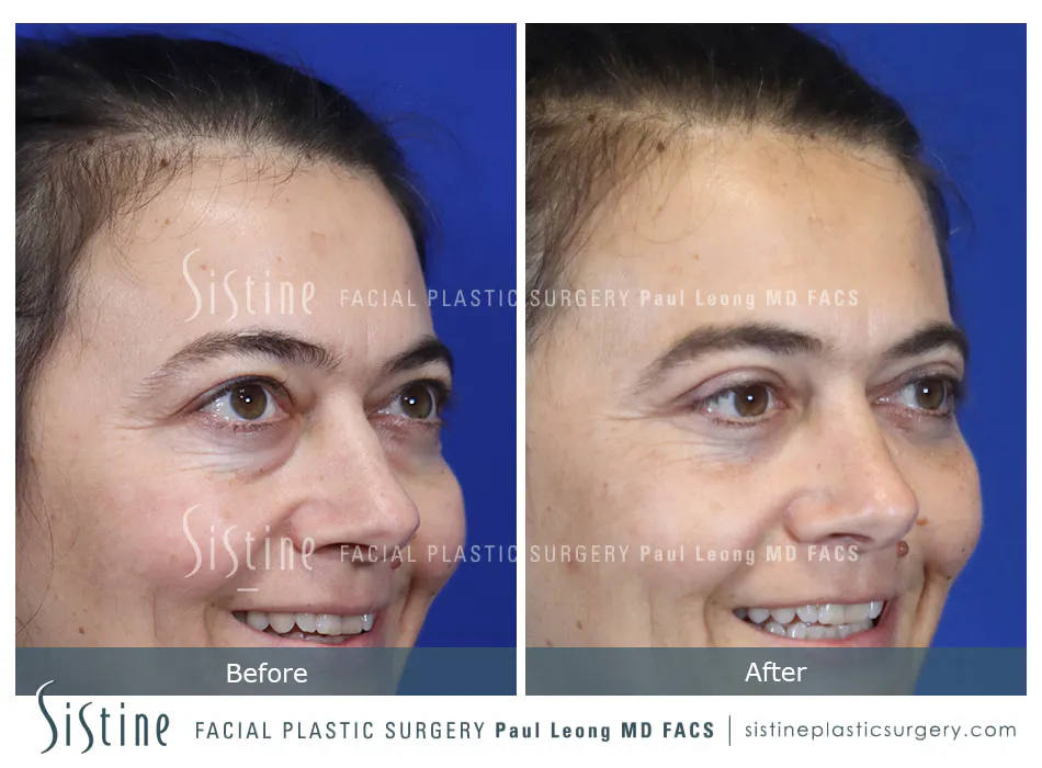 Pittsburgh High SMAS Facelift - Preoperative Right Lateral View | Sistine Facial Plastic Surgery