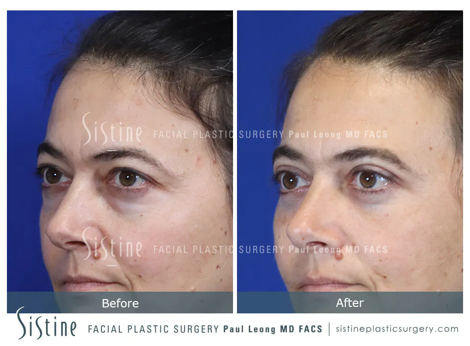 Pittsburgh High SMAS Facelift - Preoperative Left Later Chin Tucked View  Sistine Facial Plastic Surgery