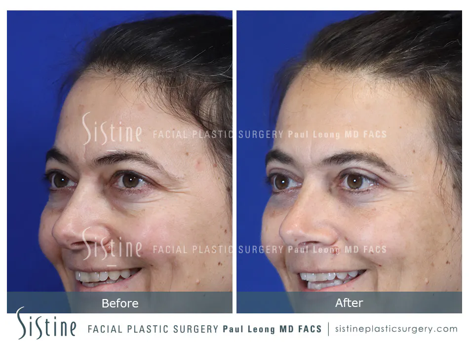 Pittsburgh High SMAS Facelift - Preoperative Left Later Chin Tucked View  Sistine Facial Plastic Surgery