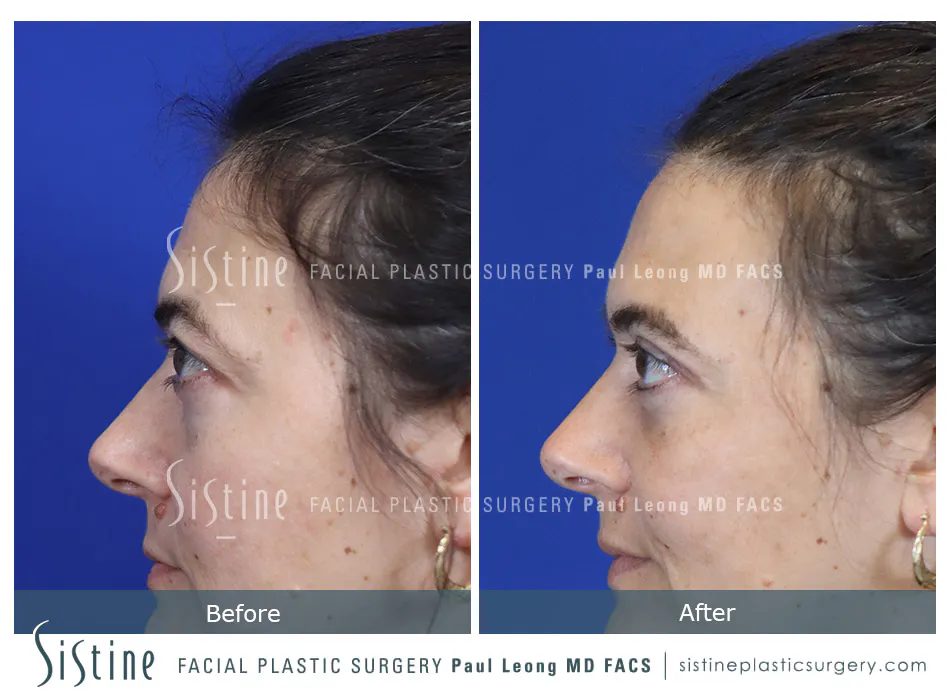 Pittsburgh High SMAS Facelift - Preoperative Left Later Chin Tucked View  Sistine Facial Plastic Surgery