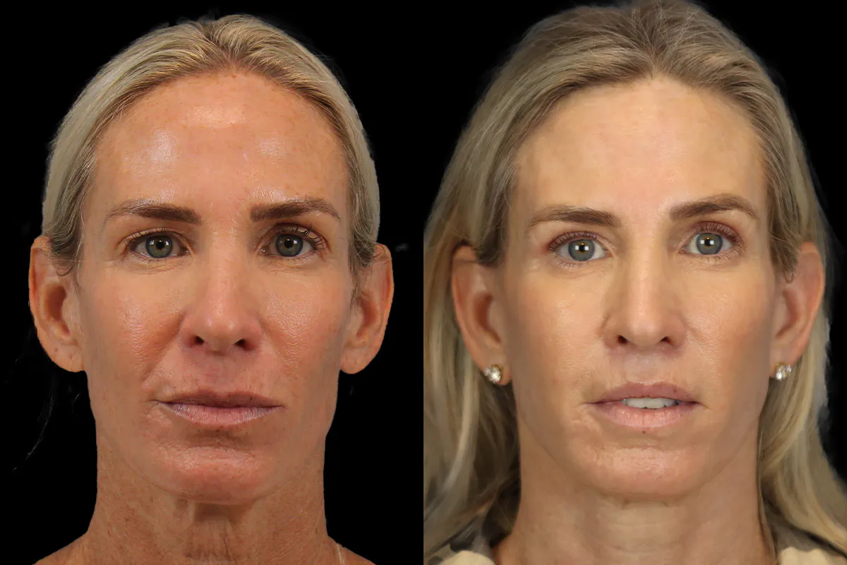 Lip Lift Before and After | Leong Facial Plastic Surgery