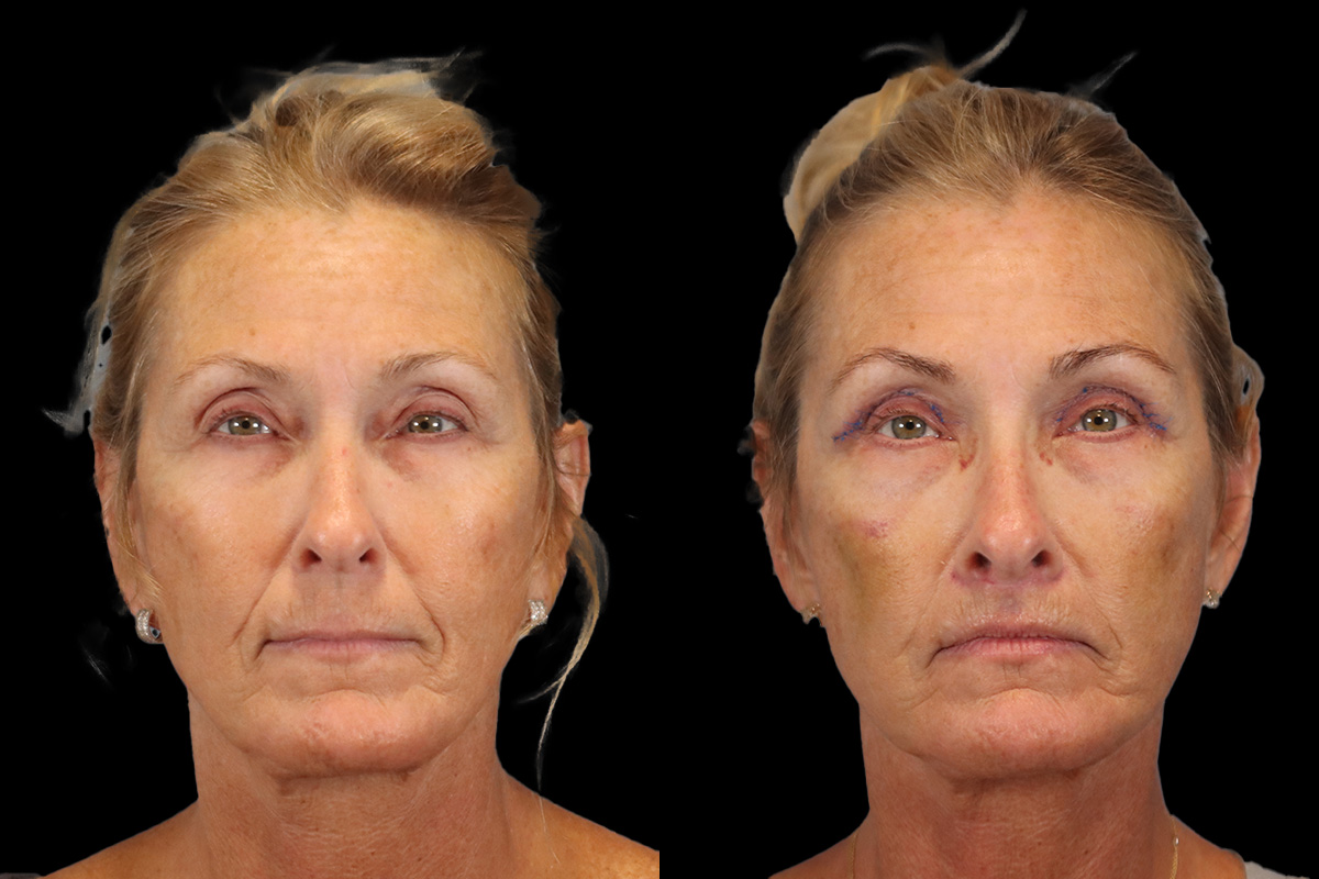 Lip Lift Before and After | Leong Facial Plastic Surgery