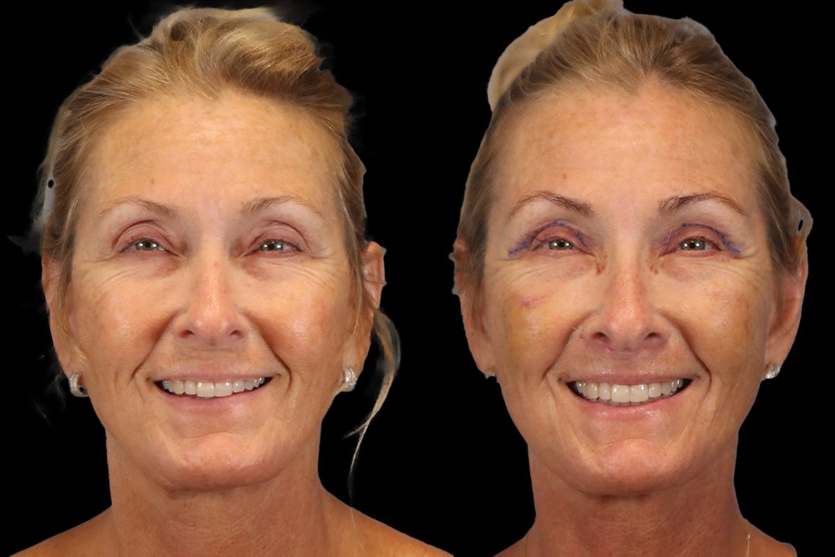 Lip Lift Before and After | Leong Facial Plastic Surgery