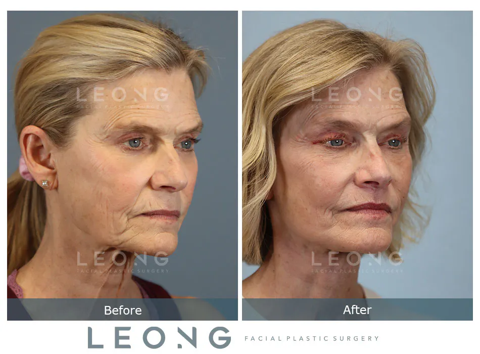 Lip Lift Before and After | Leong Facial Plastic Surgery