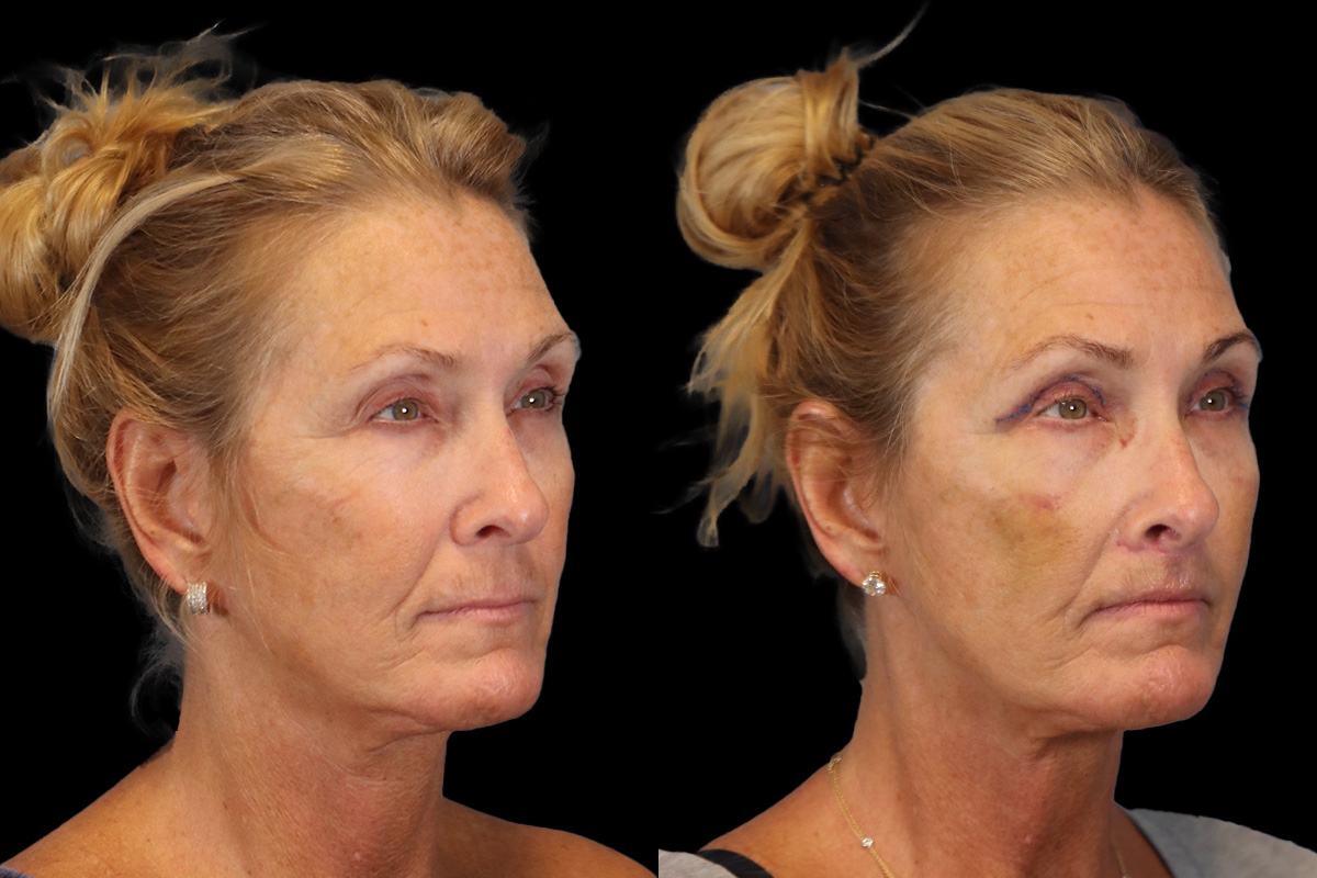 Lip Lift Before and After | Leong Facial Plastic Surgery