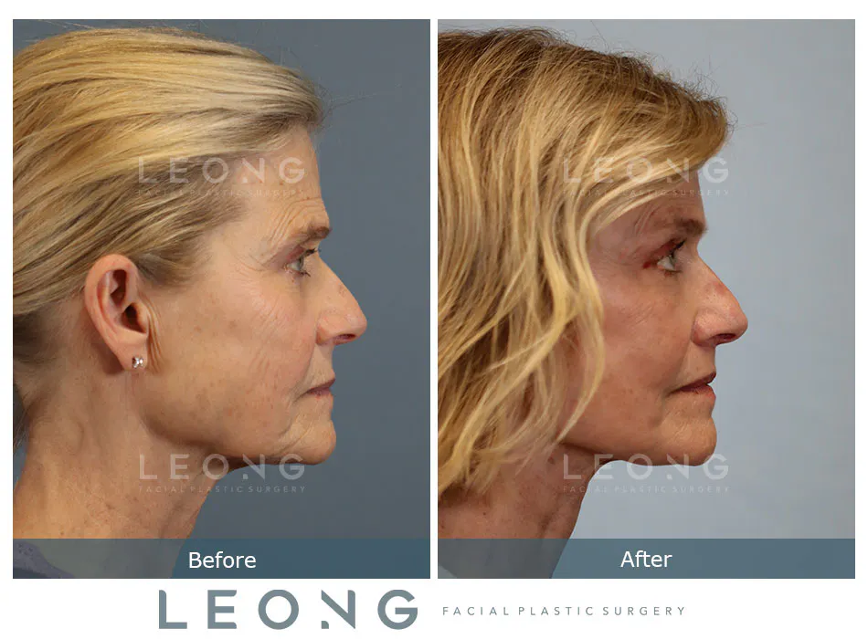 Lip Lift Before and After | Leong Facial Plastic Surgery