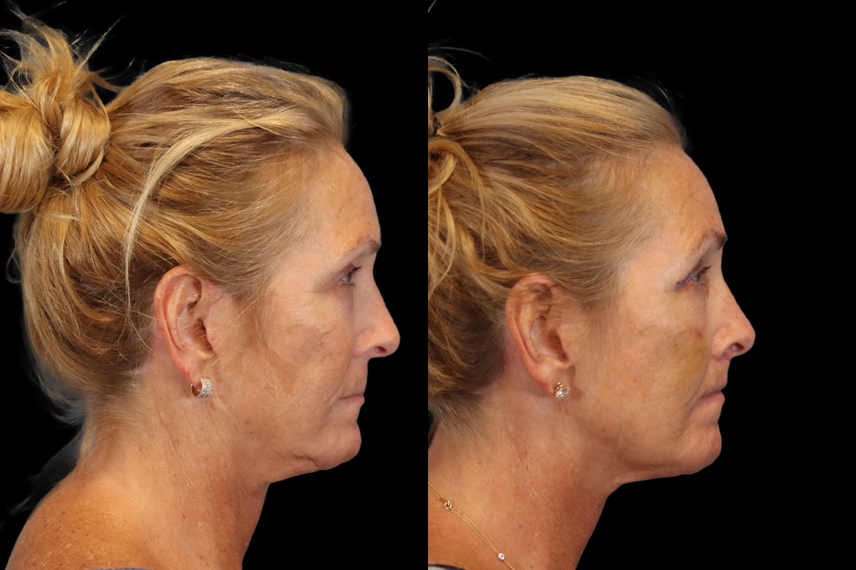 Lip Lift Before and After | Leong Facial Plastic Surgery