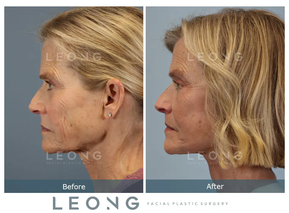 Lip Lift Before and After | Leong Facial Plastic Surgery