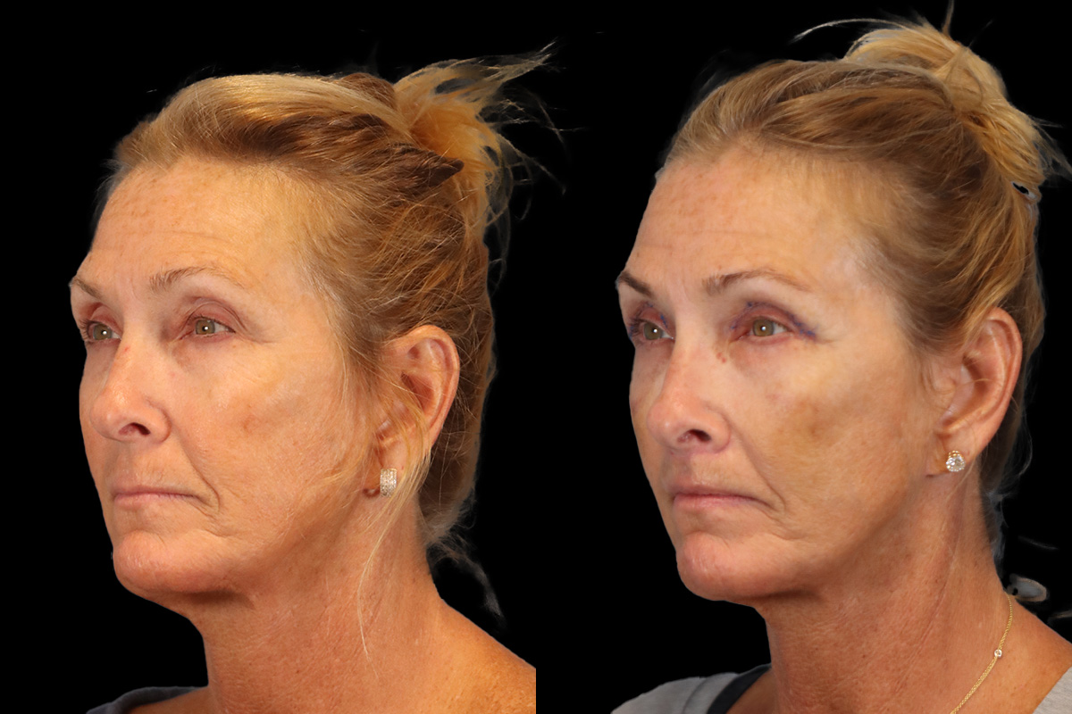 Lip Lift Before and After | Leong Facial Plastic Surgery