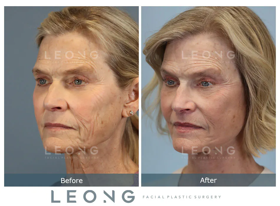 Lip Lift Before and After | Leong Facial Plastic Surgery