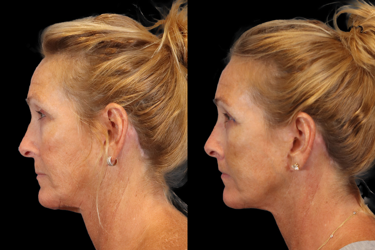 Lip Lift Before and After | Leong Facial Plastic Surgery