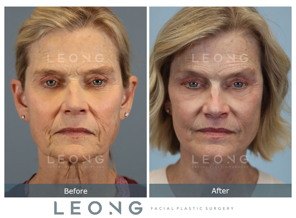 Lip Lift Before and After | Leong Facial Plastic Surgery