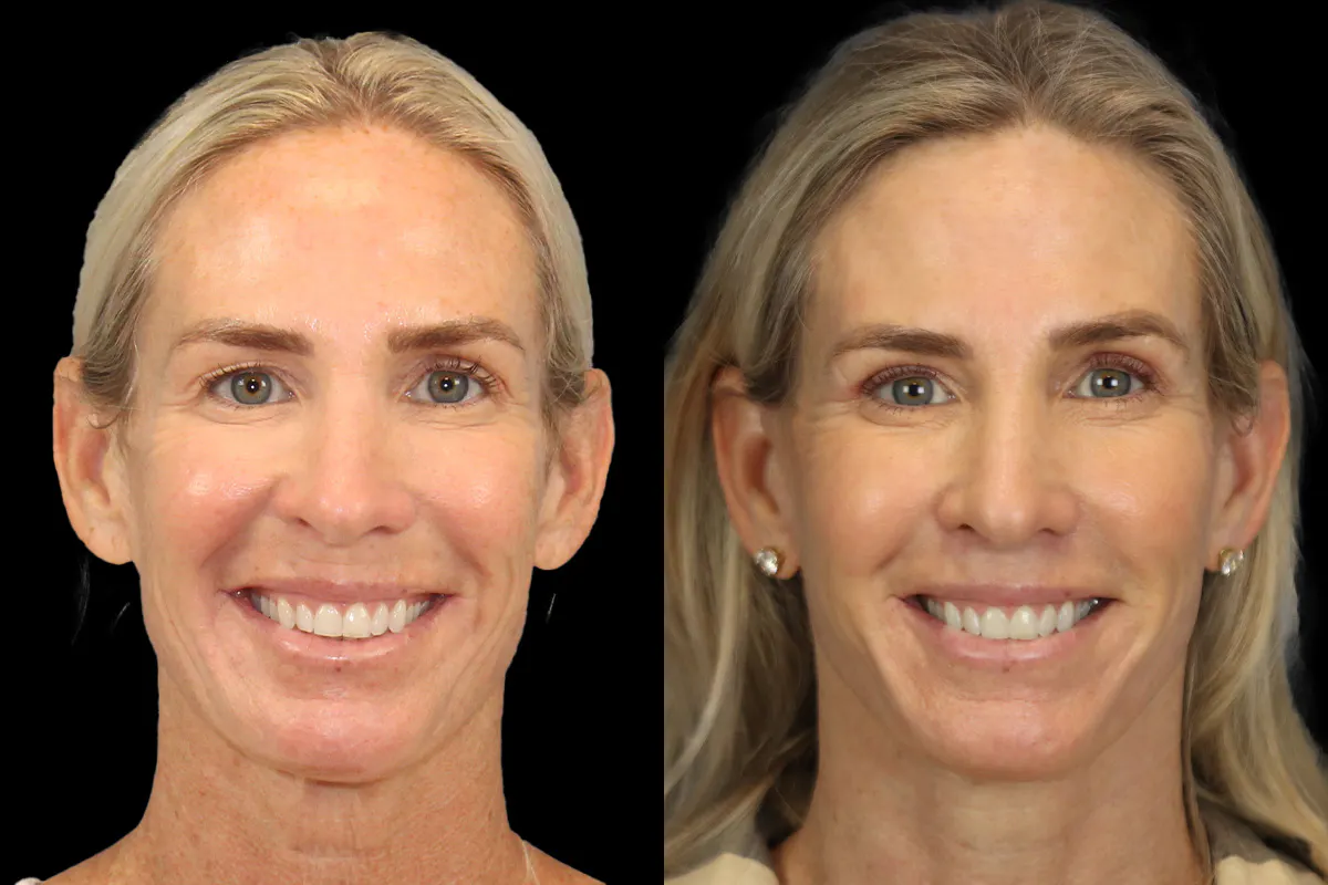 Lip Lift Before and After | Leong Facial Plastic Surgery