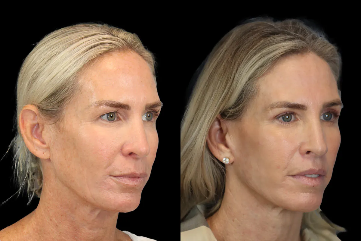 Lip Lift Before and After | Leong Facial Plastic Surgery