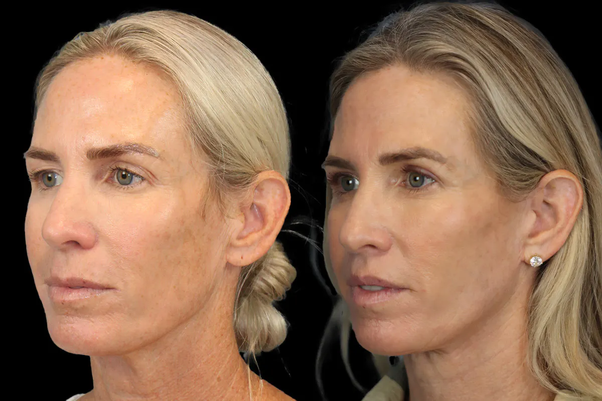 Lip Lift Before and After | Leong Facial Plastic Surgery