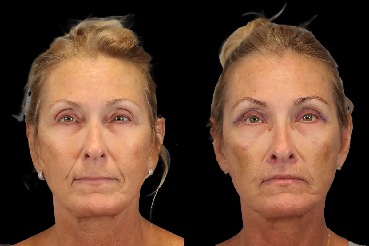 Lip Lift Before and After | Leong Facial Plastic Surgery