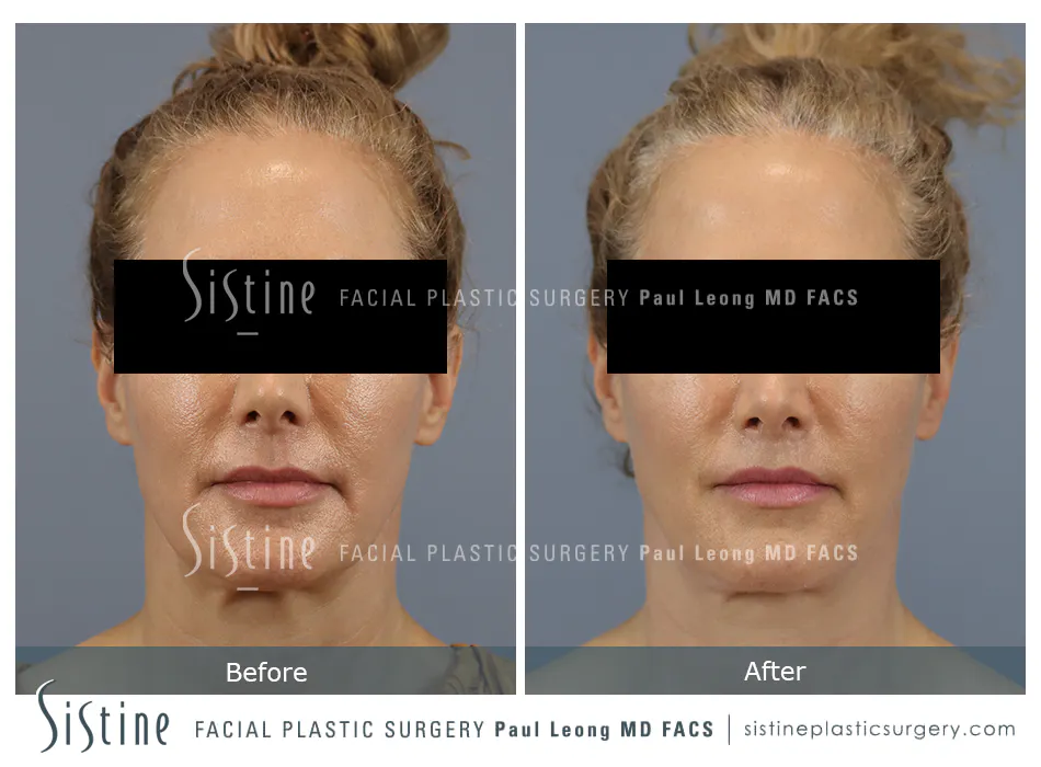 Lip Lift Before and After | Leong Facial Plastic Surgery