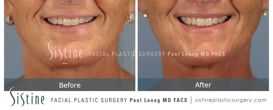Lip Lift Before and After | Leong Facial Plastic Surgery