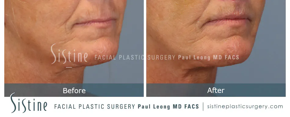 Lip Lift Before and After | Leong Facial Plastic Surgery