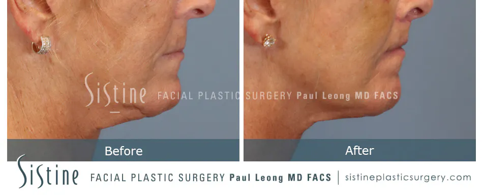 Lip Lift Before and After | Leong Facial Plastic Surgery