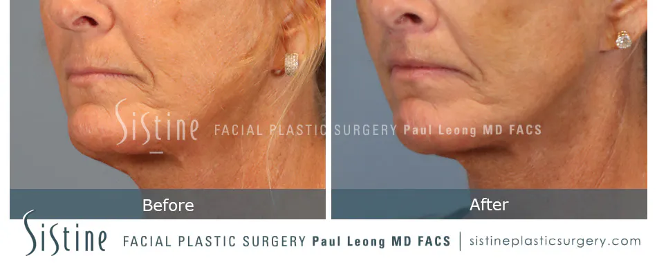 Lip Lift Before and After | Leong Facial Plastic Surgery