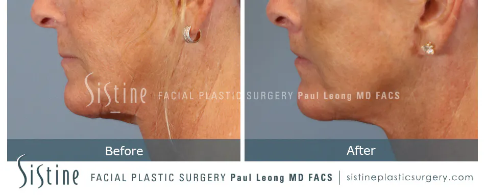 Lip Lift Before and After | Leong Facial Plastic Surgery