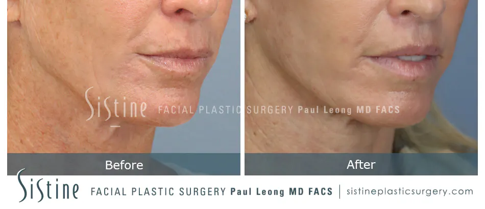 Lip Lift Before and After | Leong Facial Plastic Surgery