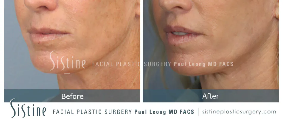Lip Lift Before and After | Leong Facial Plastic Surgery