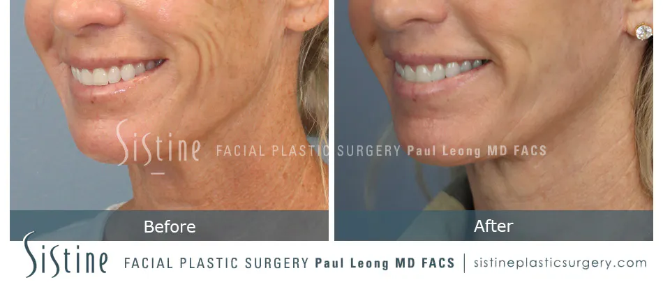 Lip Lift Before and After | Leong Facial Plastic Surgery