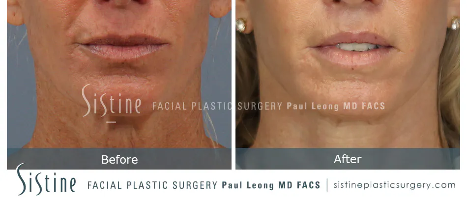 Lip Lift Before and After | Leong Facial Plastic Surgery