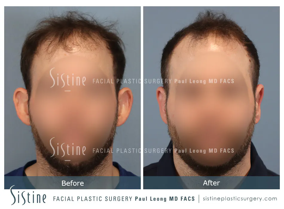 Otoplasty Before and After | Leong Facial Plastic Surgery
