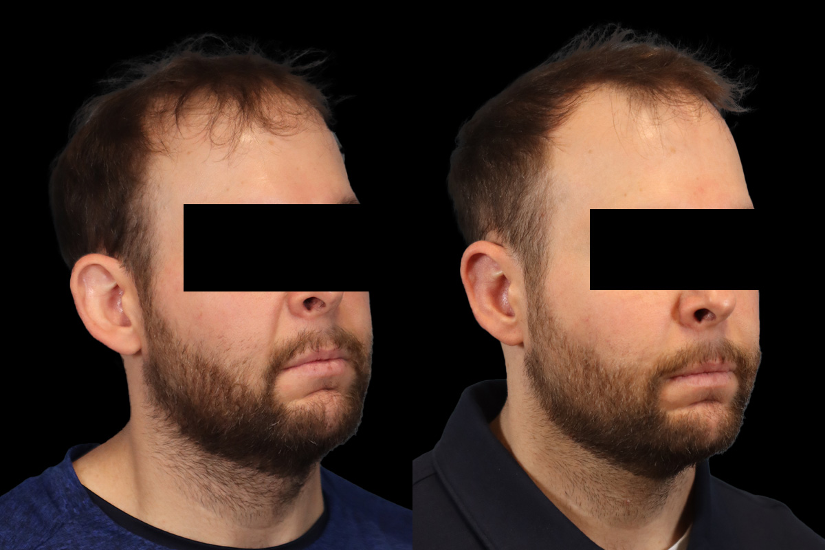 Otoplasty Before and After | Leong Facial Plastic Surgery