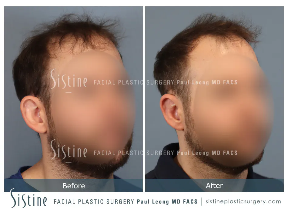 Otoplasty Before and After | Leong Facial Plastic Surgery