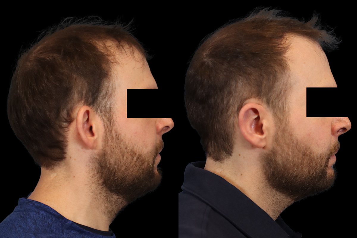 Otoplasty Before and After | Leong Facial Plastic Surgery
