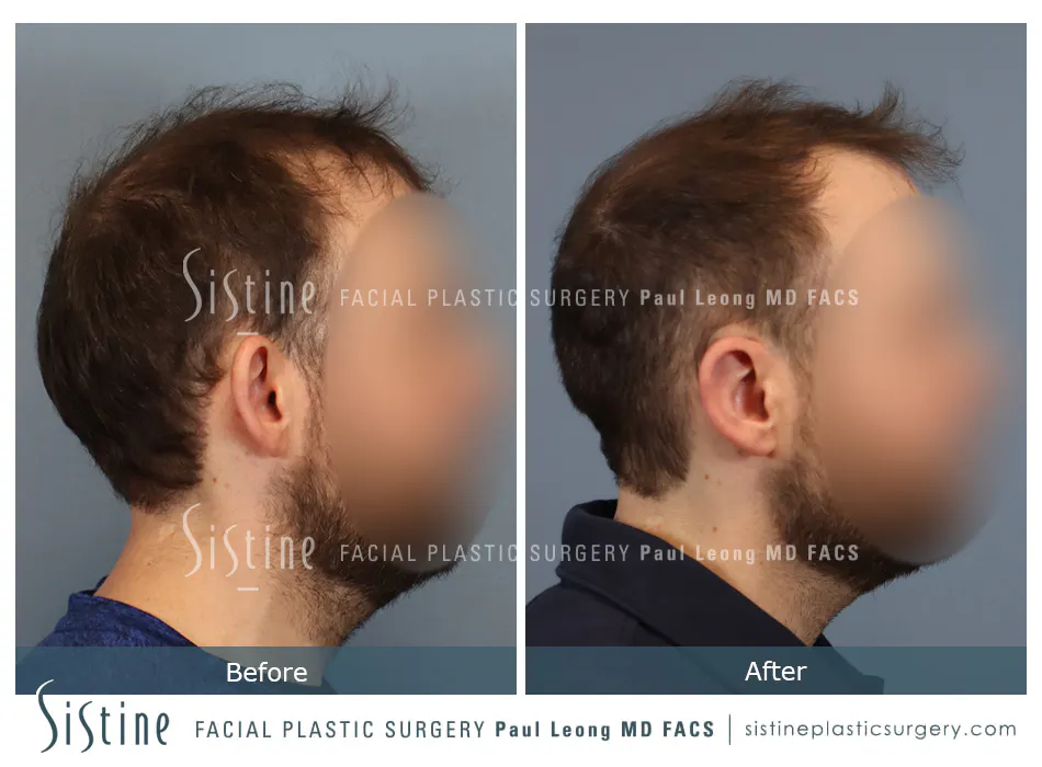 Otoplasty Before and After | Leong Facial Plastic Surgery