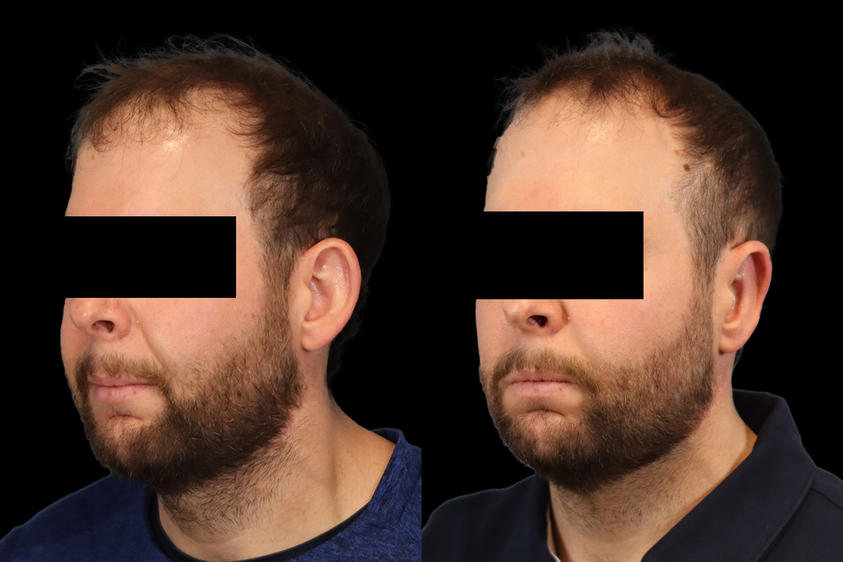 Otoplasty Before and After | Leong Facial Plastic Surgery
