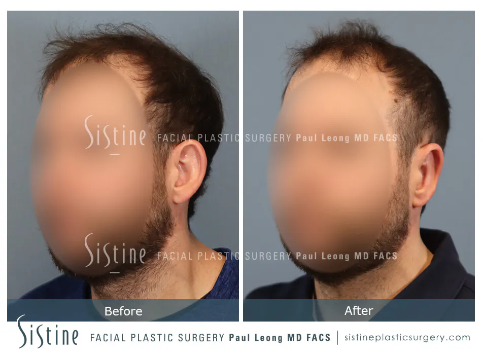 Otoplasty Before and After | Leong Facial Plastic Surgery