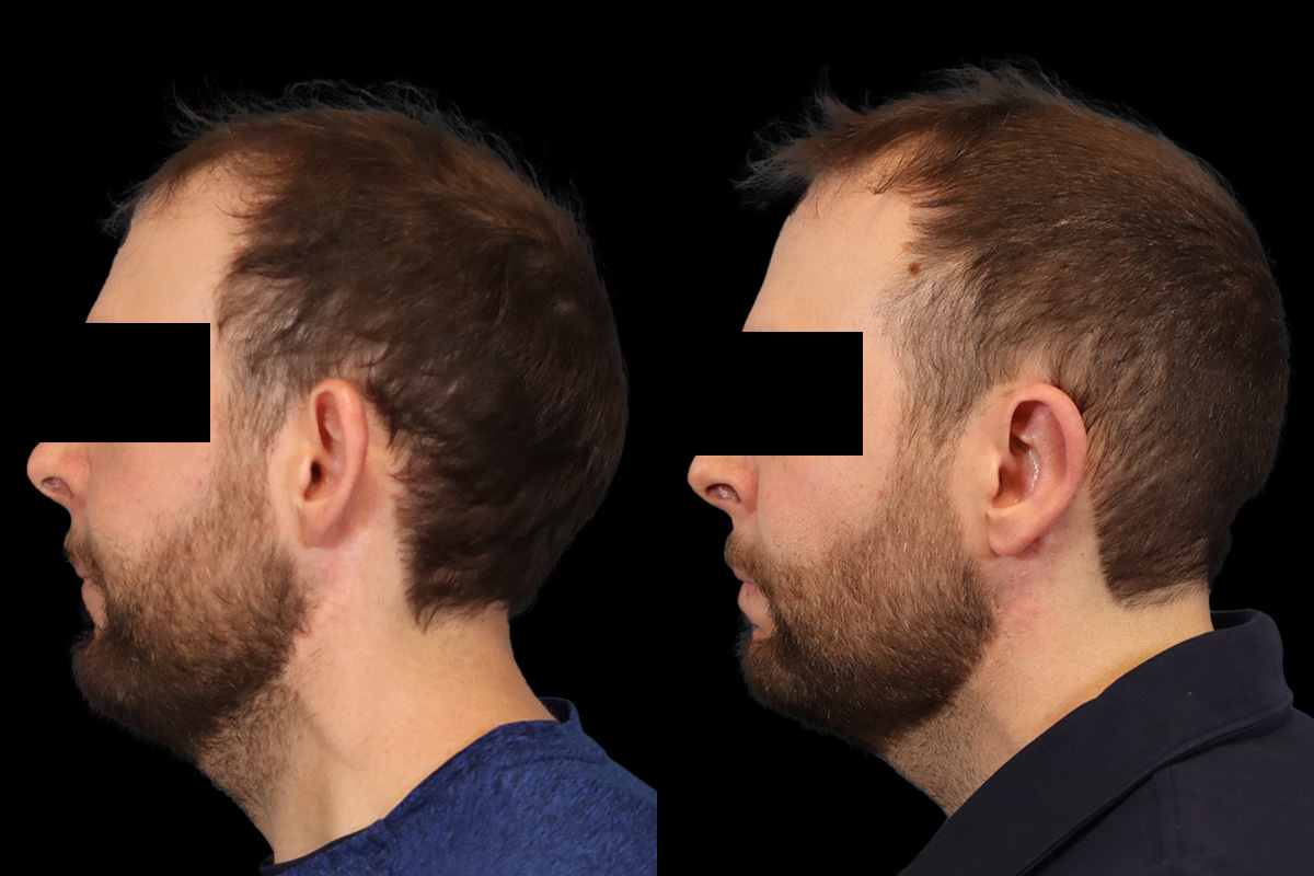 Otoplasty Before and After | Leong Facial Plastic Surgery