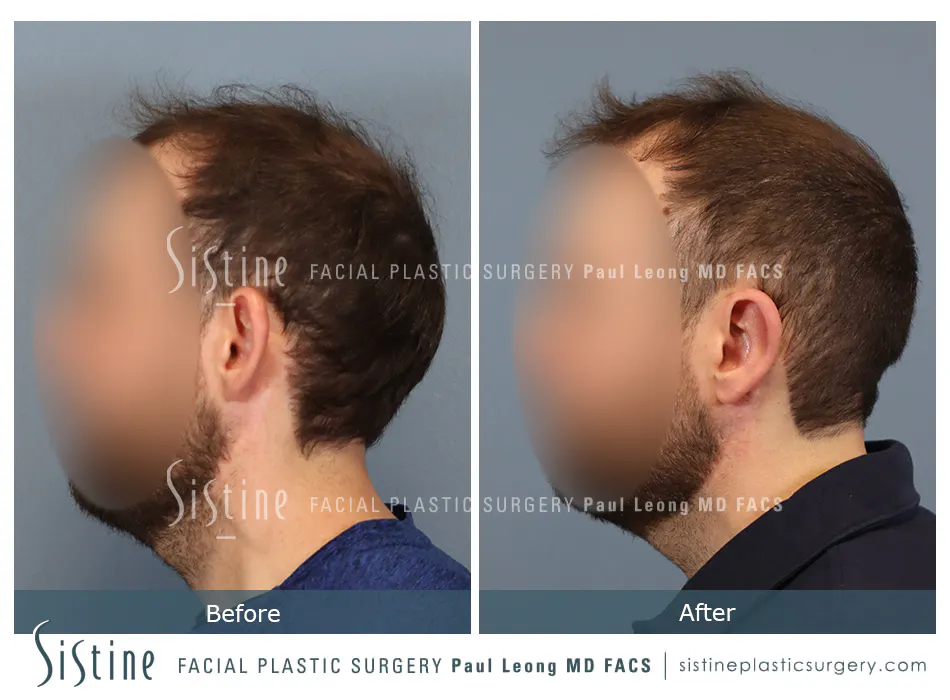 Otoplasty Before and After | Leong Facial Plastic Surgery