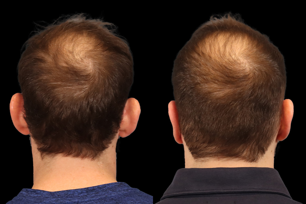 Otoplasty Before and After | Leong Facial Plastic Surgery