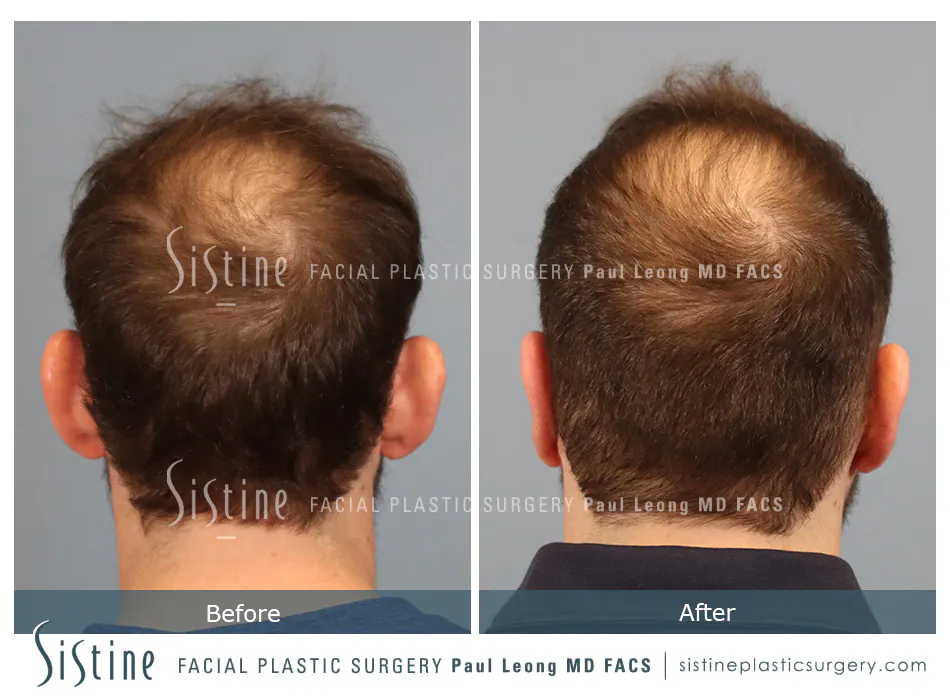 Otoplasty Before and After | Leong Facial Plastic Surgery