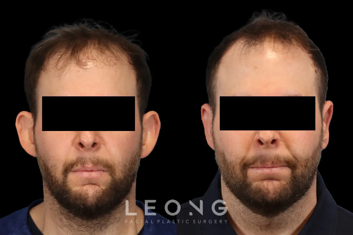 Otoplasty Before and After | Leong Facial Plastic Surgery