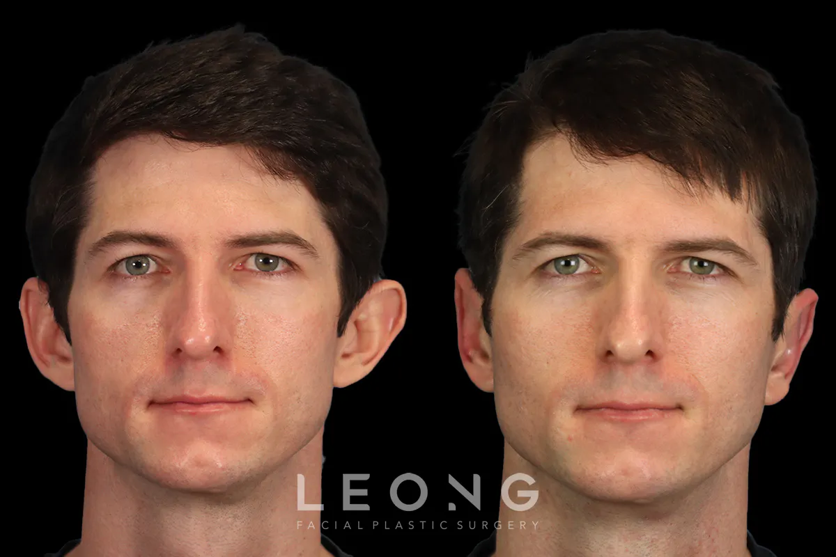Otoplasty Before and After | Leong Facial Plastic Surgery