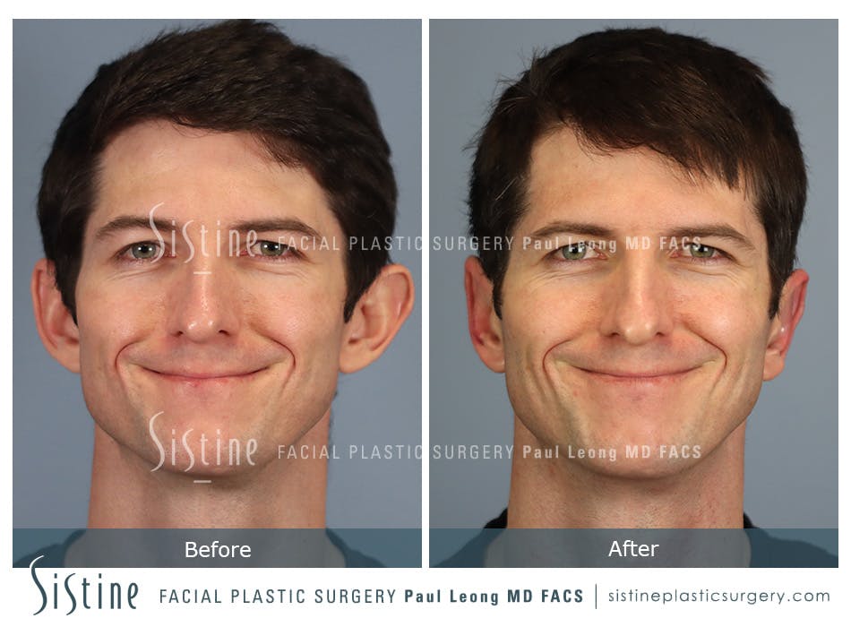 Otoplasty Before and After | Leong Facial Plastic Surgery