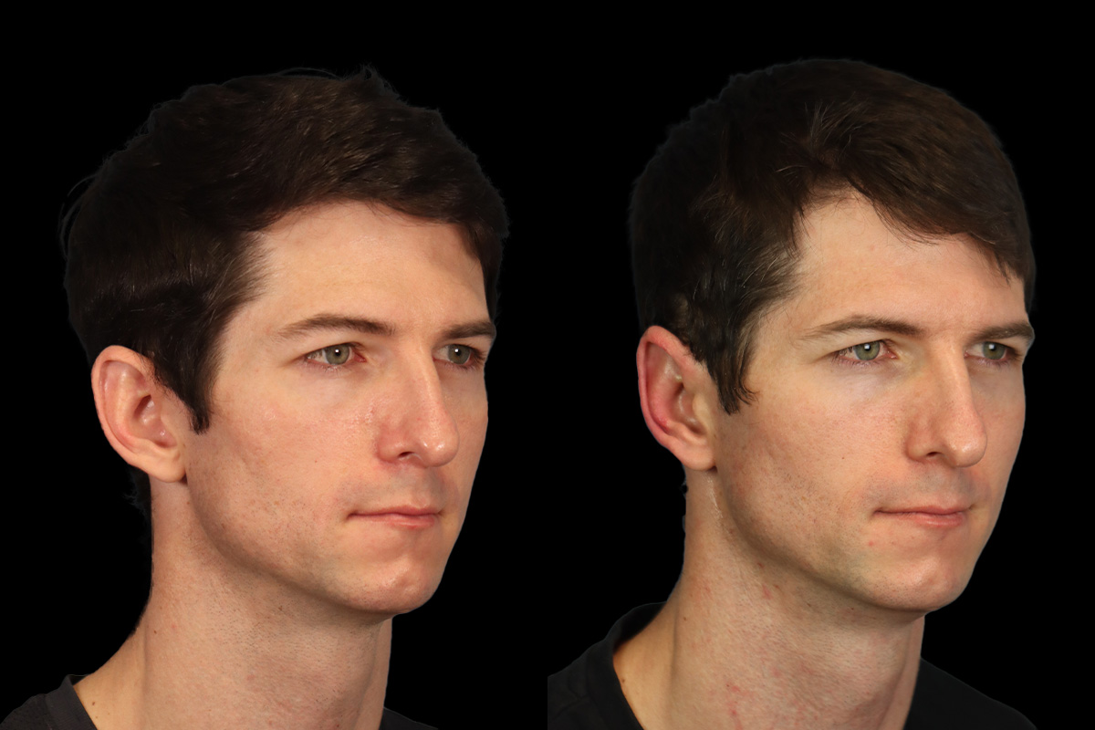 Otoplasty Before and After | Leong Facial Plastic Surgery