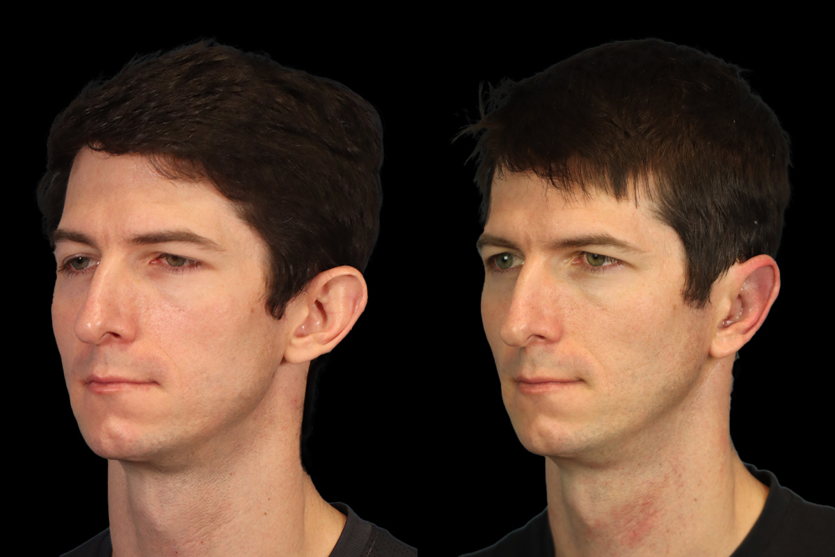 Otoplasty Before and After | Leong Facial Plastic Surgery