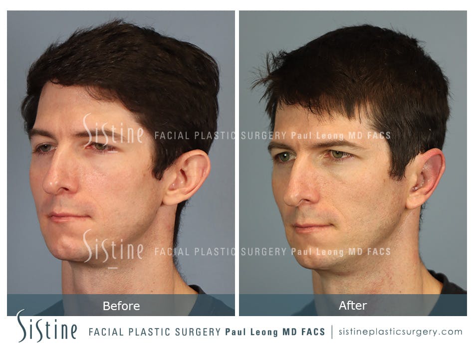Otoplasty Before and After | Leong Facial Plastic Surgery