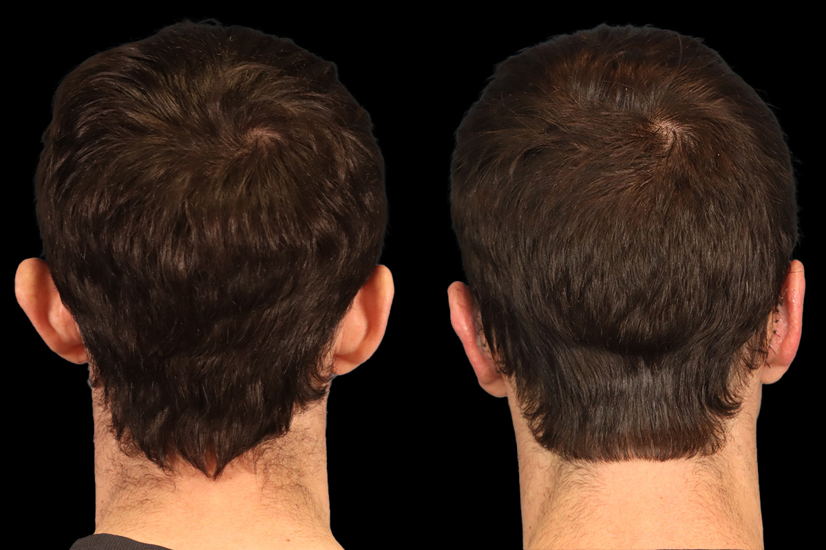 Otoplasty Before and After | Leong Facial Plastic Surgery
